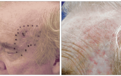 Basal Cell Carcinoma Case Study