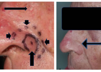 Radiothérapie du cancer de la peau chez un patient porteur d'une mutation PTEN